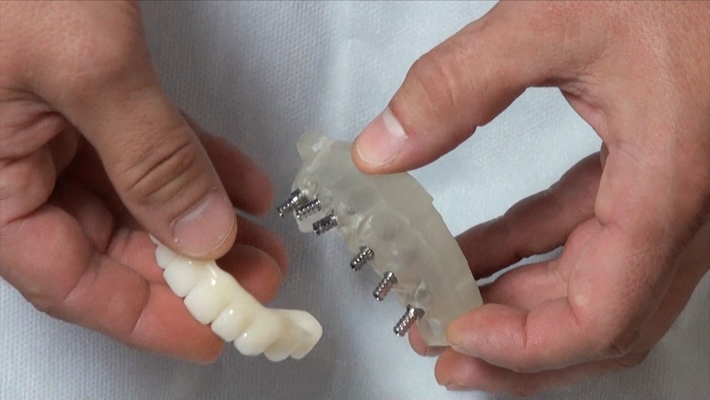 Zahnloser Kiefer: Schraubkanäle vorhersagbar planen