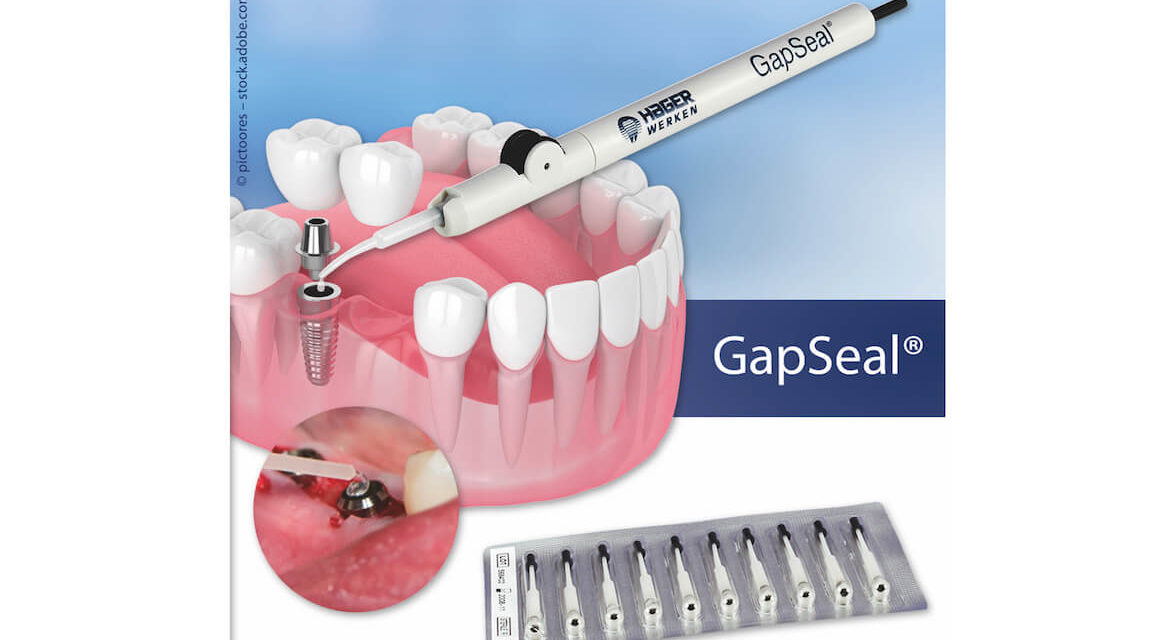 GapSeal: Microleakage bei Implantaten stoppen