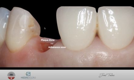Session 1: Immediate placement and immediate loading – Single crown from molar to high esthetic region