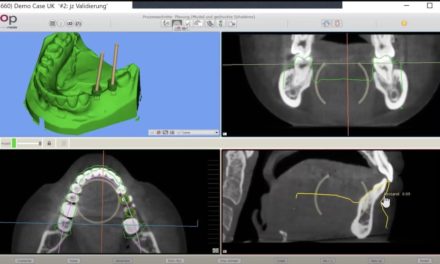 Implantologie im digitalen Workflow mit SMOP