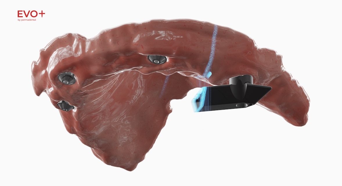 EVO+ by PERMADENTAL: Eine Evolution in der digitalen Full-Arch-Implantatversorgung