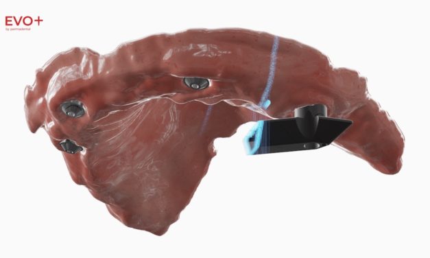 EVO+ by PERMADENTAL: Eine Evolution in der digitalen Full-Arch-Implantatversorgung