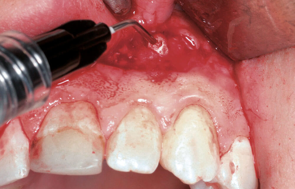 Hyaluronsäure in der dentalen Chirurgie