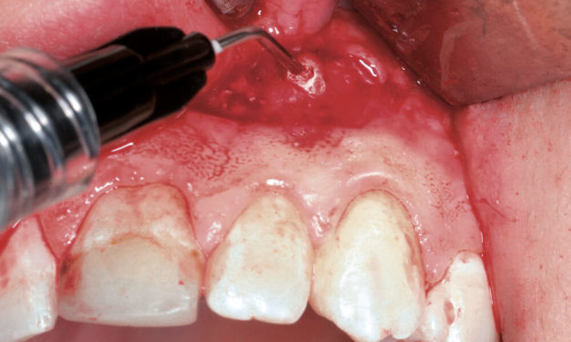 Hyaluronsäure in der dentalen Chirurgie