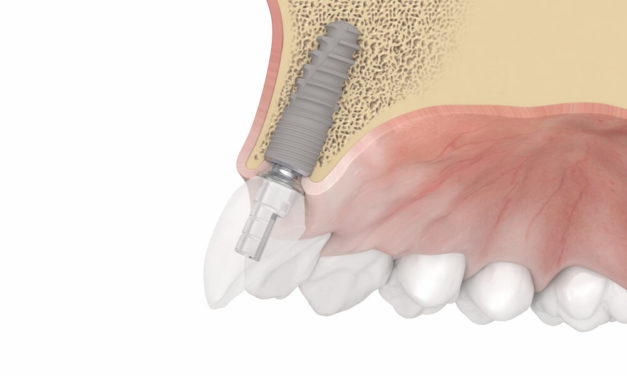 Neue Titanbasis Vario: Dentaurum Implants baut das Sortiment weiter aus