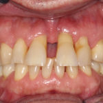 Ästhetische Rehabilitation einer parodontal nicht erhaltungsfähigen Oberkieferfront
