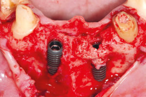 Implantatprothetische Rehabilitation einer Nichtanlage
