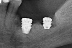Knochennekrosen durch orale Bisphosphonate nach Einsetzen eines Zahnimplantats