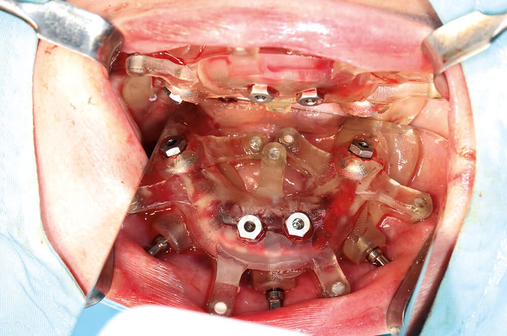 Abb 10 Präzise Implantationen mittels aufgesteckter Implantationsschiene.