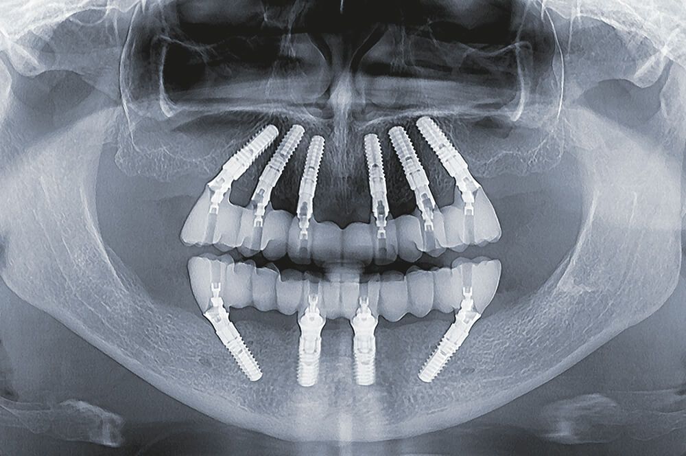 Abb 13 Röntgenkontrollaufnahme der Sofortprovisorien im OK und UK mit stabil eingeheilten Implantaten (sechs Monate nach dem Eingriff).
