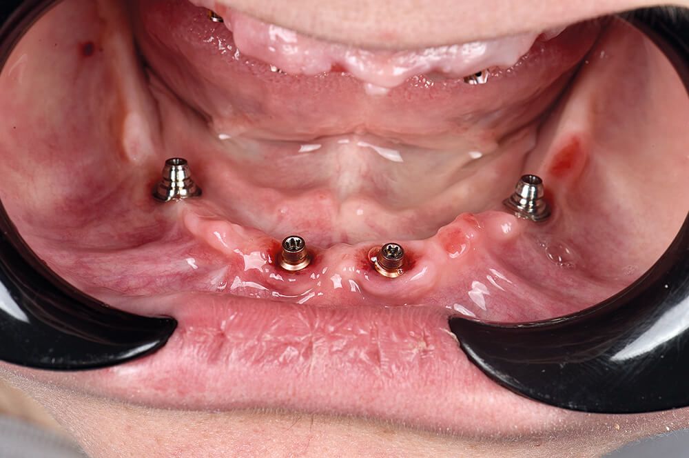 Abb 14 Komplikationslos abgeheiltes und an den blueSky-Implantaten (bredent) …