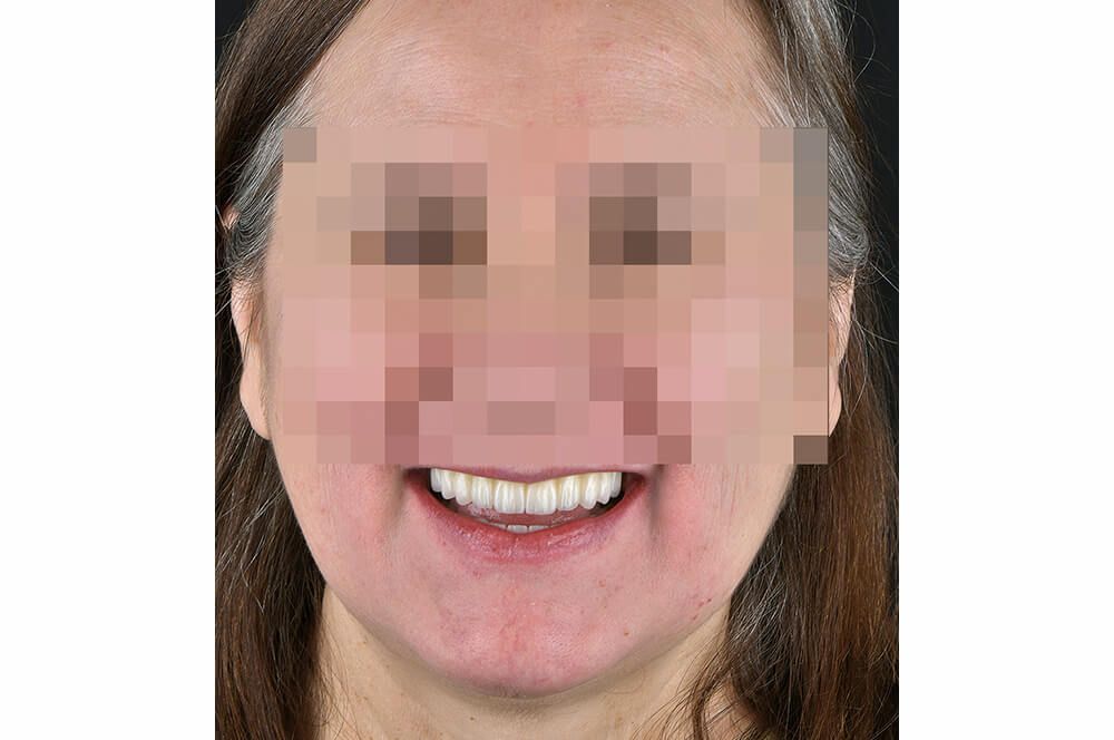Abb 19 … und nach der implantatprothetischen Full-Arch Restauration.