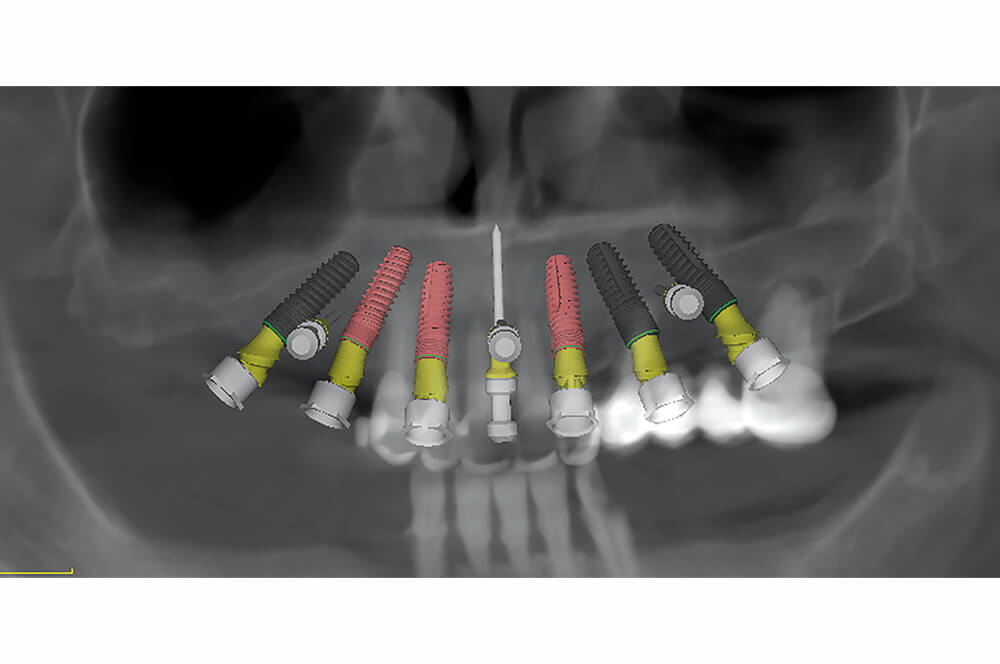 Abb 2 Implantatplanung für den Ober- und Unterkiefer mit anguliert gesetzten …