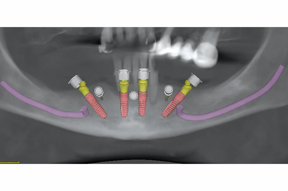 Abb 3 … endständigen Implantaten nach dem Sky fast & fixed Konzept (bredent).
