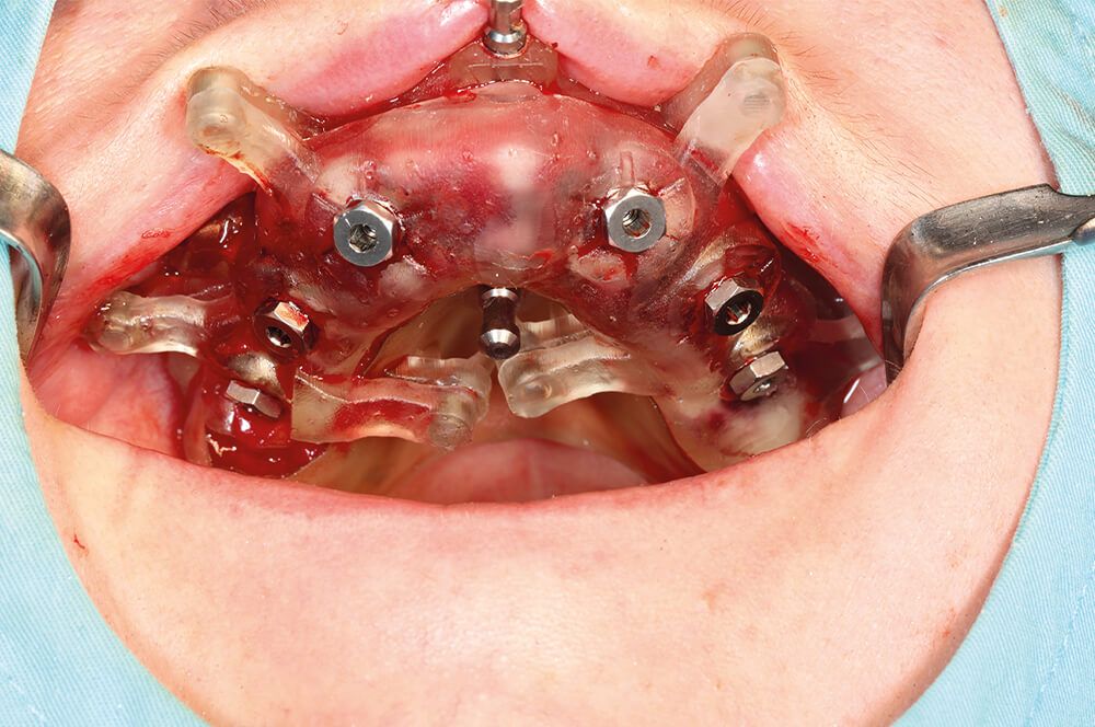 Abb 6 Durch die aufgesteckte Implantationsschiene eingebrachte Implantate im Oberkiefer.