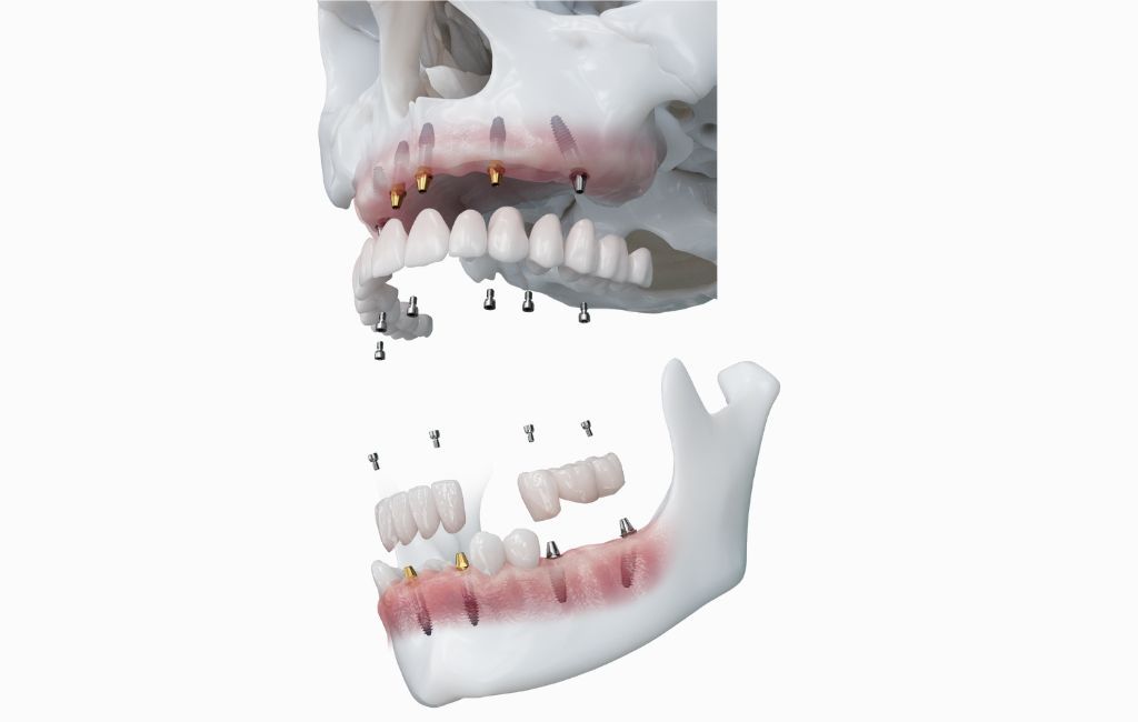Implantatpflege